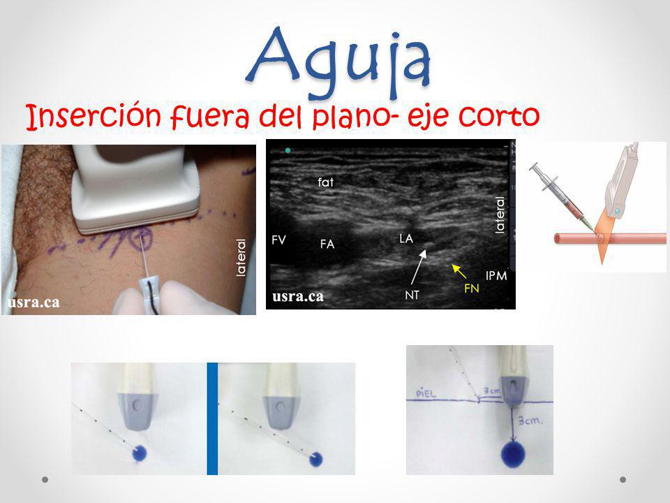 Aguja Inserción fuera del plano- eje corto