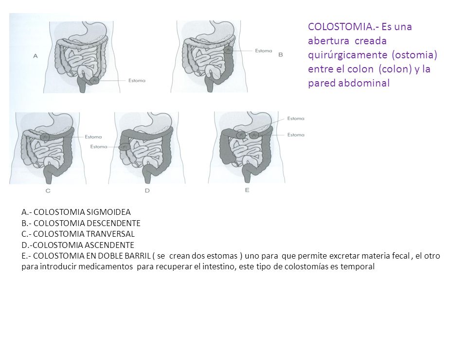 COLOSTOMIA.- Es una abertura creada quirúrgicamente (ostomia) entre el colon (colon) y la pared abdominal