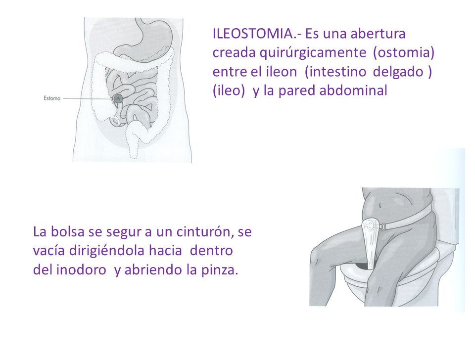 ILEOSTOMIA.- Es una abertura creada quirúrgicamente (ostomia) entre el ileon (intestino delgado ) (ileo) y la pared abdominal