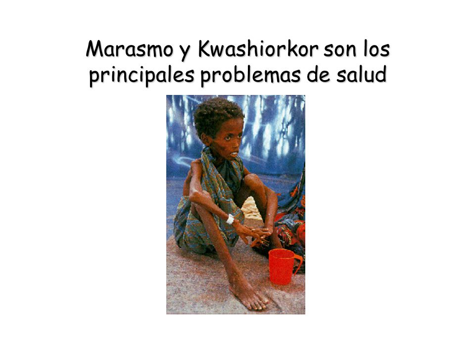Marasmo y Kwashiorkor son los principales problemas de salud