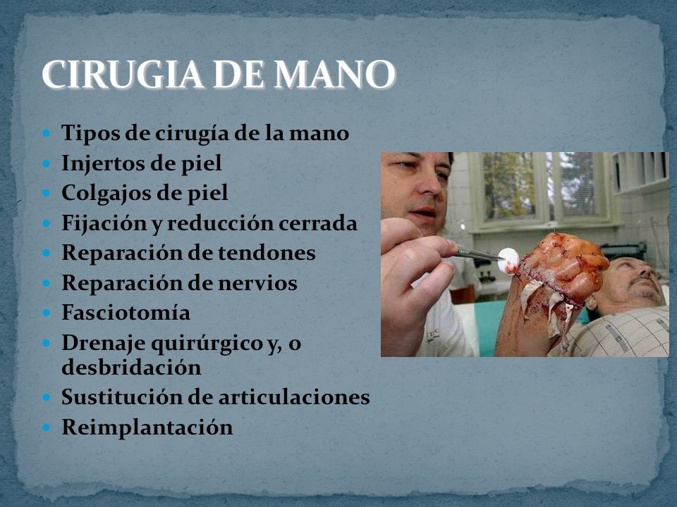 Tipos de cirugía de la mano