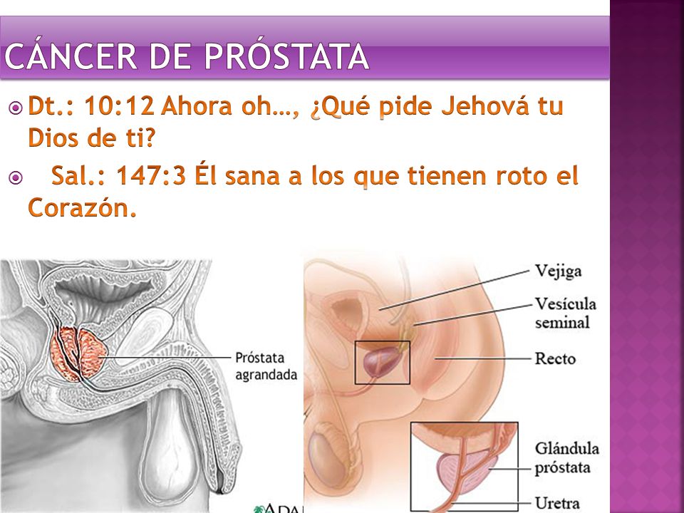 Cáncer de Próstata Dt.: 10:12 Ahora oh…, ¿Qué pide Jehová tu Dios de ti.