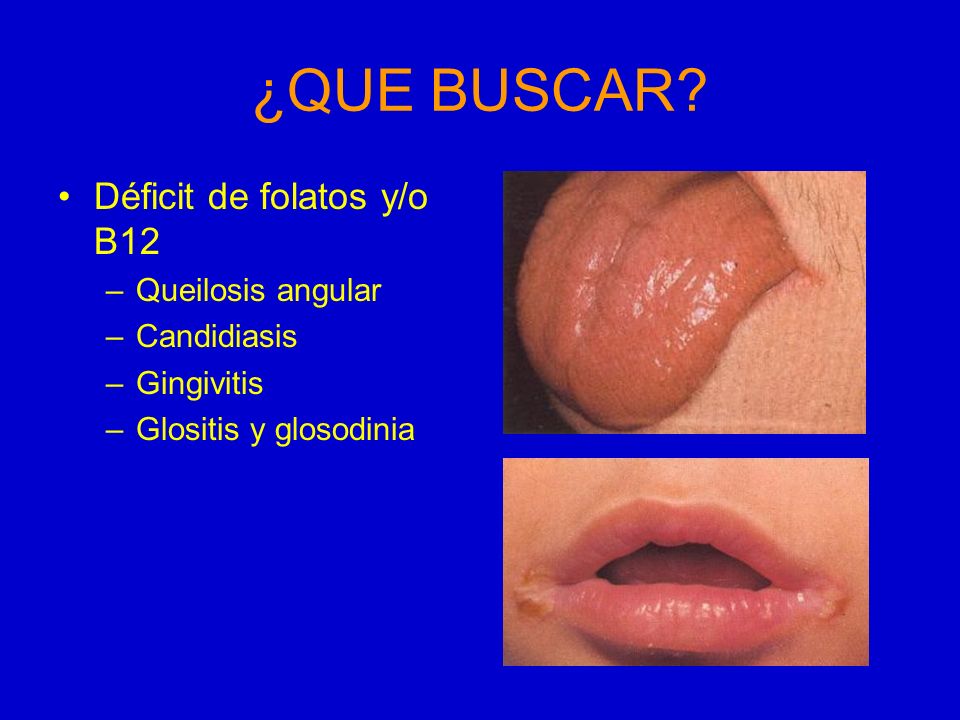 ¿QUE BUSCAR Déficit de folatos y/o B12 Queilosis angular Candidiasis
