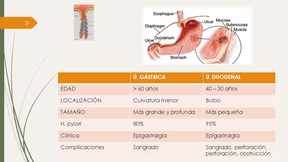 Ú. GÁSTRICA Ú. DUODENAL. EDAD. > 60 años. 40 – 50 años. LOCALIZACIÓN. Curvatura menor. Bulbo.