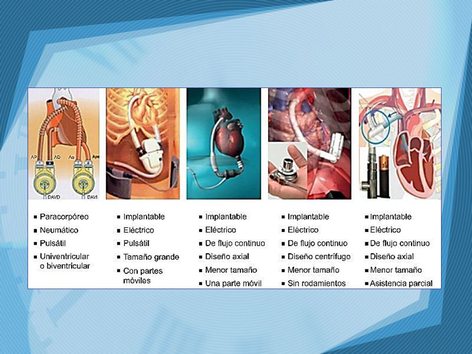 Dispositivos de asistencia de ventrículo izquierdo: ayudan al corazón a bombear la sangre