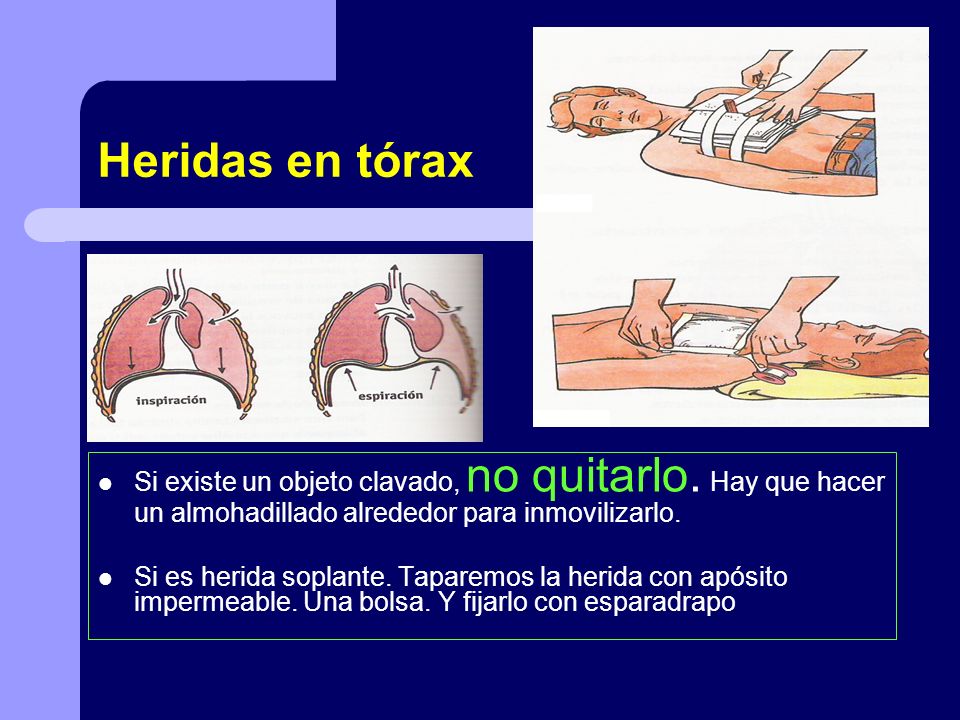 Heridas en tórax Si existe un objeto clavado, no quitarlo. Hay que hacer un almohadillado alrededor para inmovilizarlo.