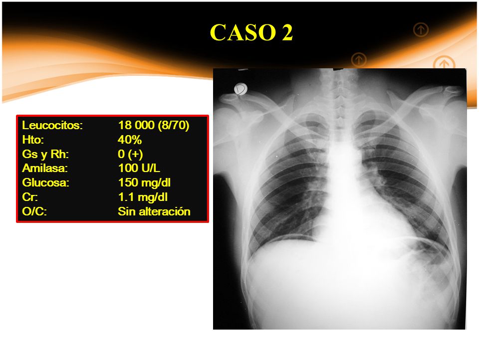 CASO 2 Leucocitos: (8/70) Hto: 40% Gs y Rh: 0 (+)