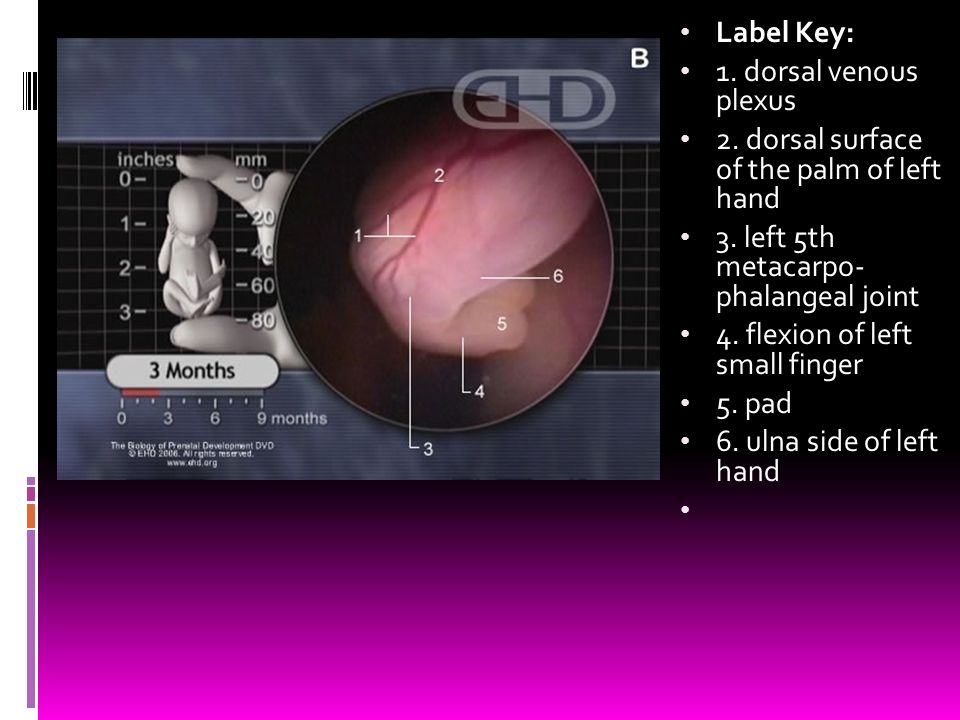 Label Key: 1. dorsal venous plexus. 2. dorsal surface of the palm of left hand. 3. left 5th metacarpo- phalangeal joint.
