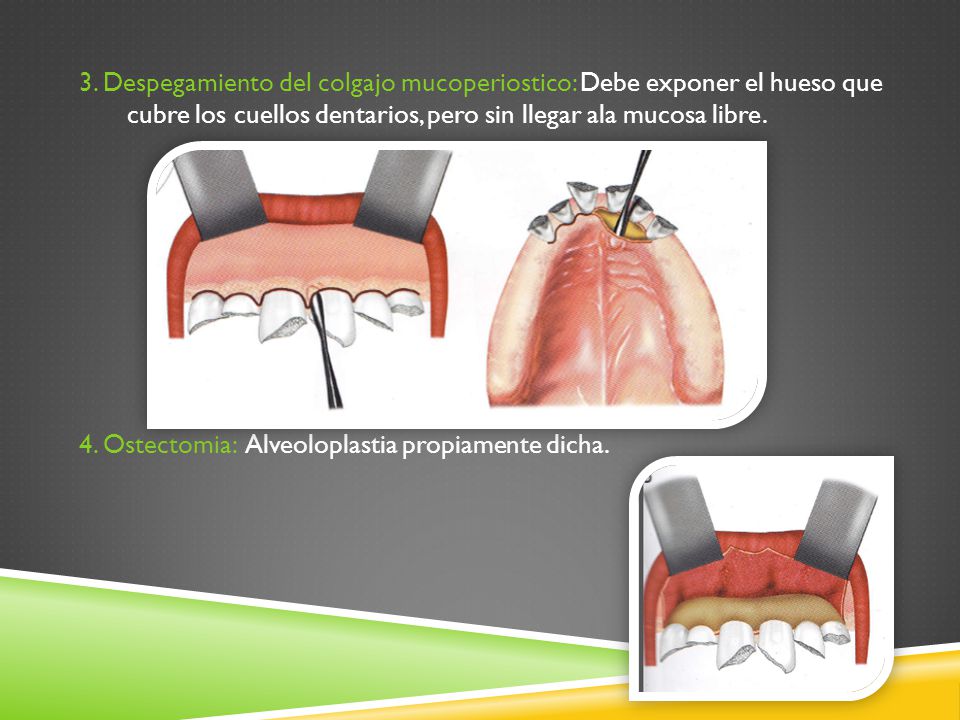 3. Despegamiento del colgajo mucoperiostico: Debe exponer el hueso que cubre los cuellos dentarios, pero sin llegar ala mucosa libre.