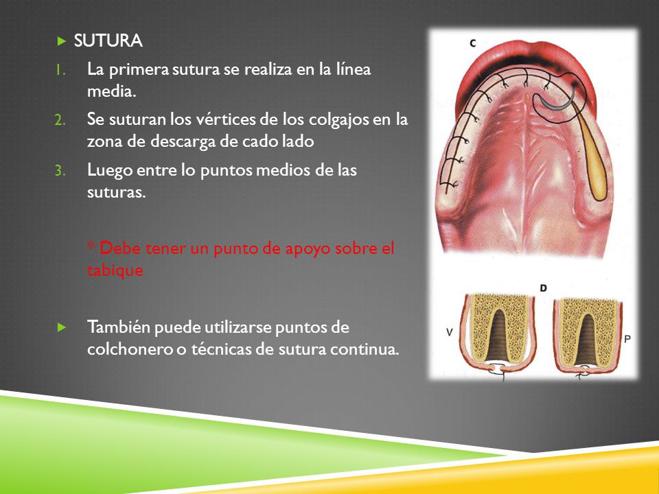 SUTURA La primera sutura se realiza en la línea media. Se suturan los vértices de los colgajos en la zona de descarga de cado lado.