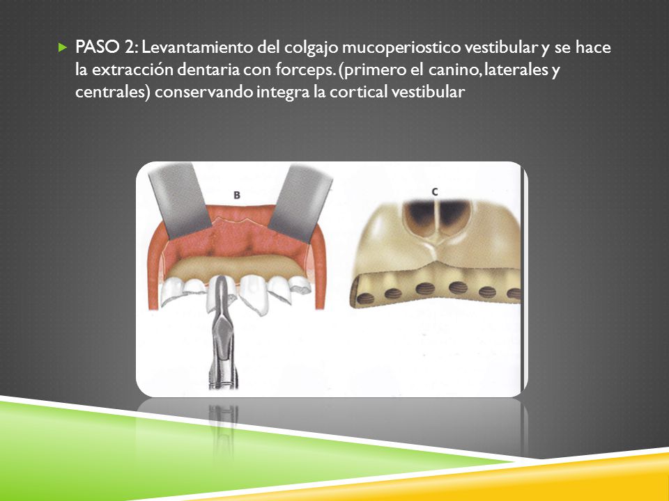 PASO 2: Levantamiento del colgajo mucoperiostico vestibular y se hace la extracción dentaria con forceps.