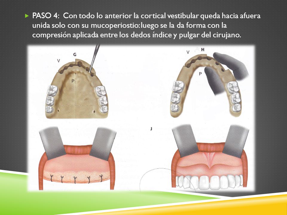 PASO 4: Con todo lo anterior la cortical vestibular queda hacia afuera unida solo con su mucoperiostio: luego se la da forma con la compresión aplicada entre los dedos índice y pulgar del cirujano.