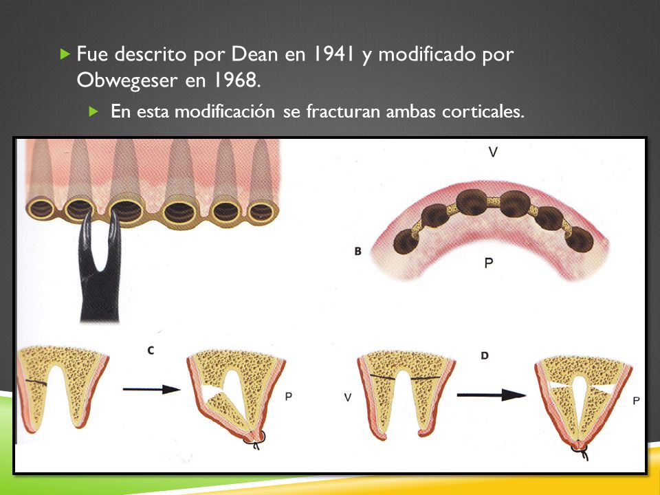 Fue descrito por Dean en 1941 y modificado por Obwegeser en 1968.