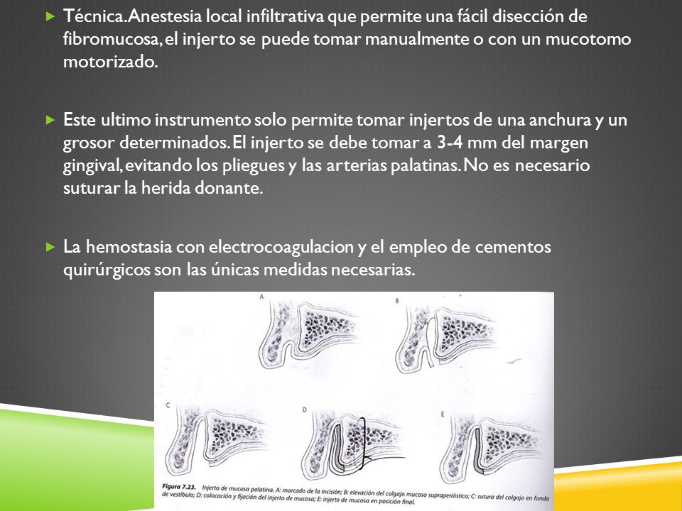 Técnica. Anestesia local infiltrativa que permite una fácil disección de fibromucosa, el injerto se puede tomar manualmente o con un mucotomo motorizado.