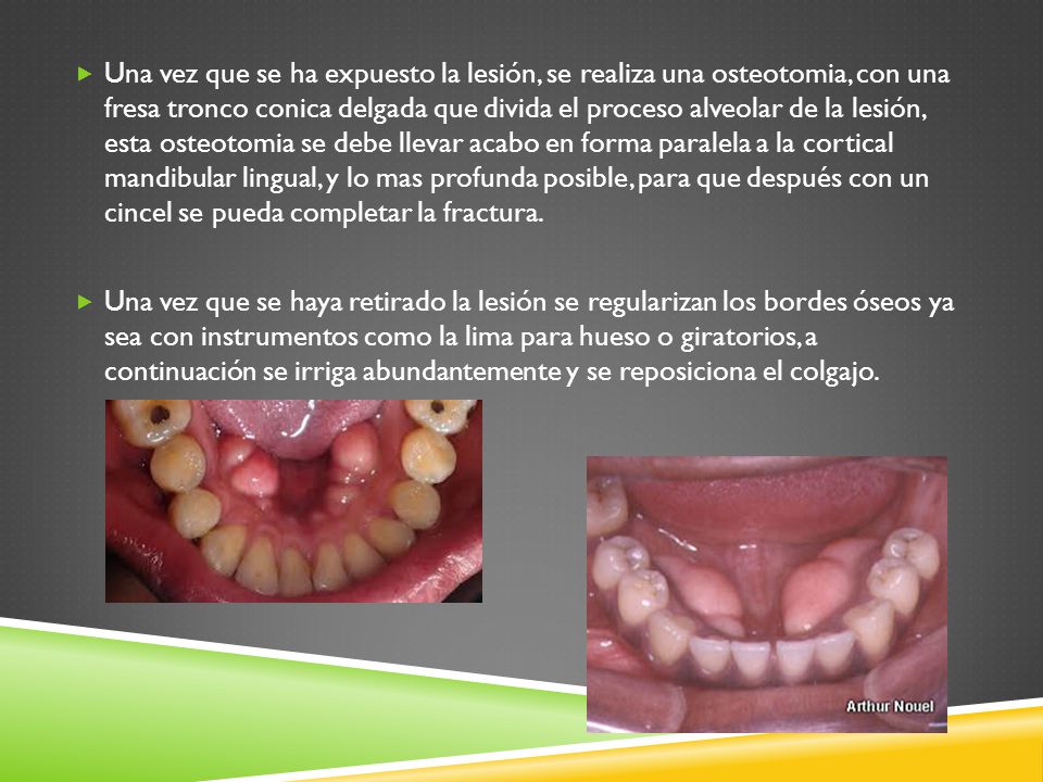 Una vez que se ha expuesto la lesión, se realiza una osteotomia, con una fresa tronco conica delgada que divida el proceso alveolar de la lesión, esta osteotomia se debe llevar acabo en forma paralela a la cortical mandibular lingual, y lo mas profunda posible, para que después con un cincel se pueda completar la fractura.
