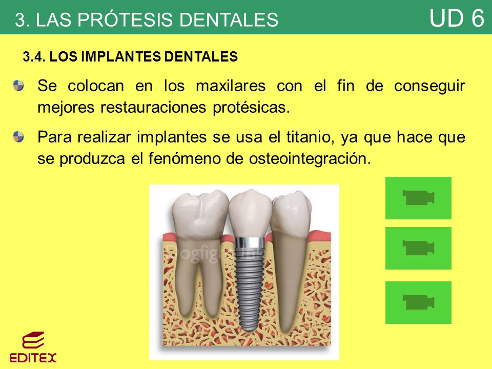 3. LAS PRÓTESIS DENTALES 3.4. LOS IMPLANTES DENTALES. Se colocan en los maxilares con el fin de conseguir mejores restauraciones protésicas.