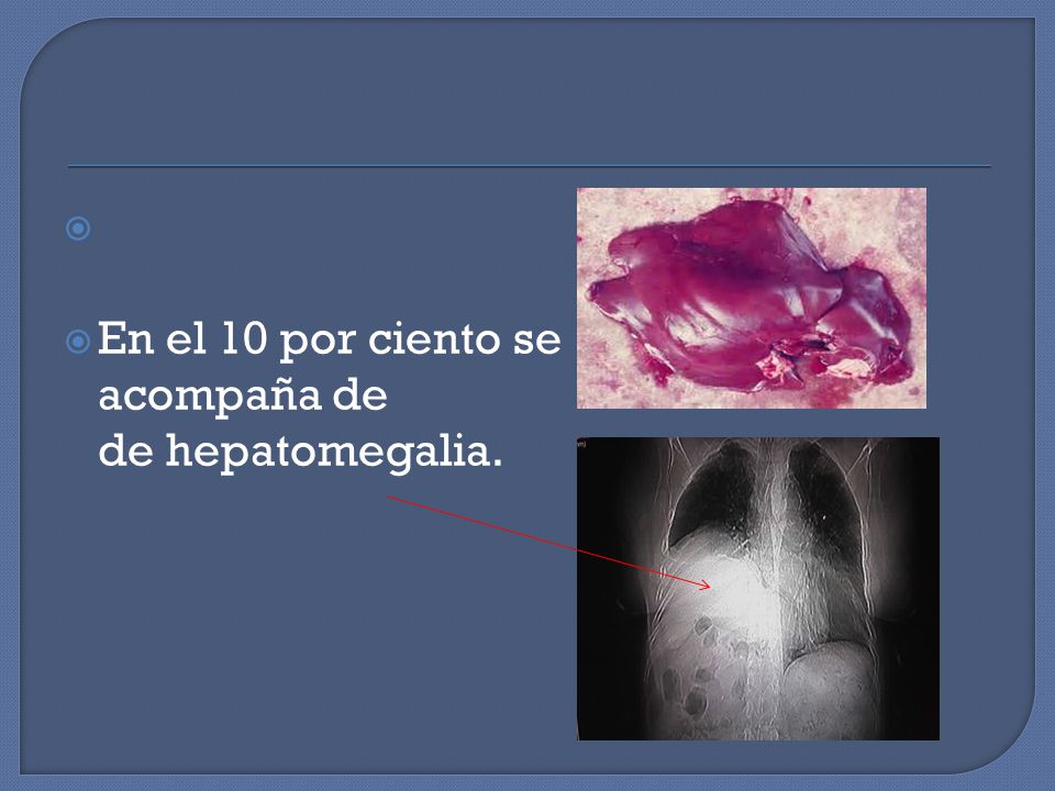 En el 10 por ciento se acompaña de de hepatomegalia.