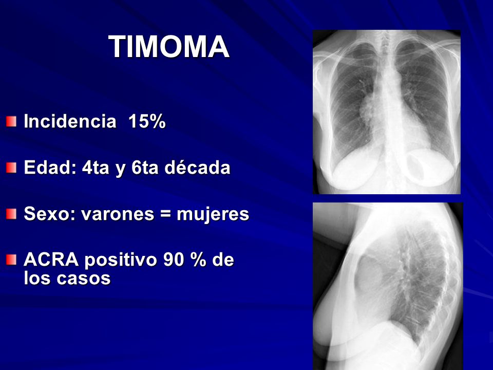 TIMOMA Incidencia 15% Edad: 4ta y 6ta década Sexo: varones = mujeres