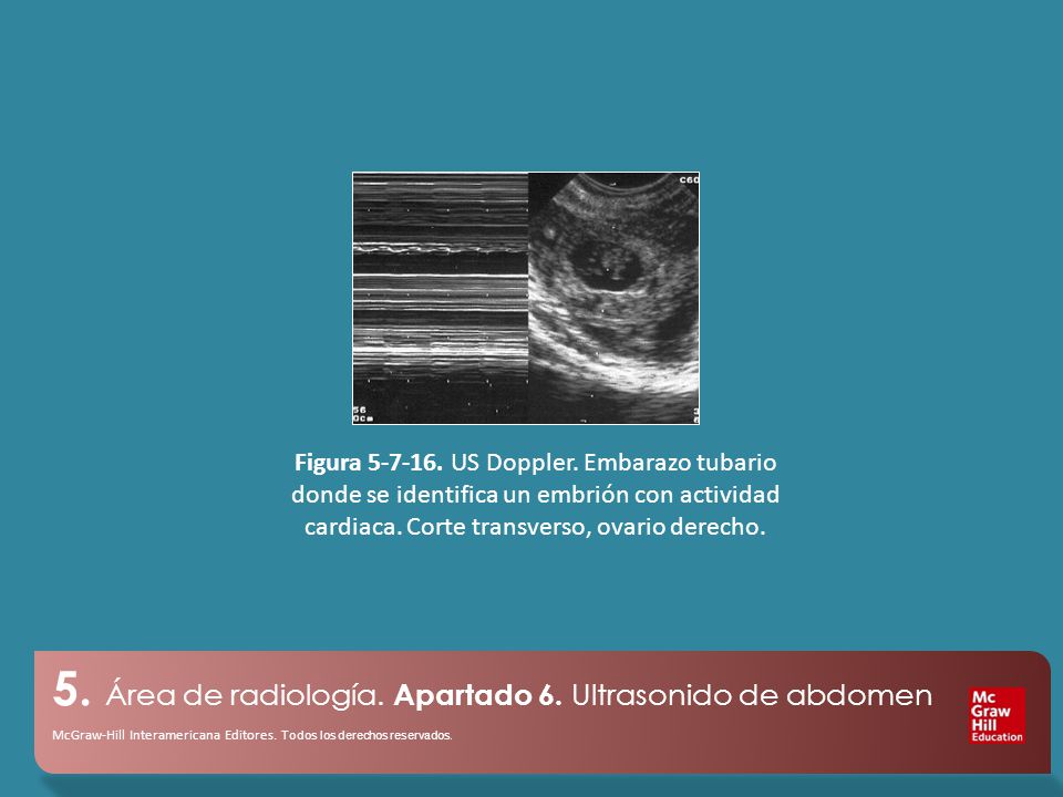 Figura US Doppler. Embarazo tubario donde se identifica un embrión con actividad cardiaca.