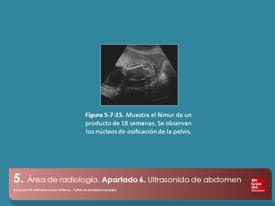 Figura Muestra el fémur de un producto de 18 semanas