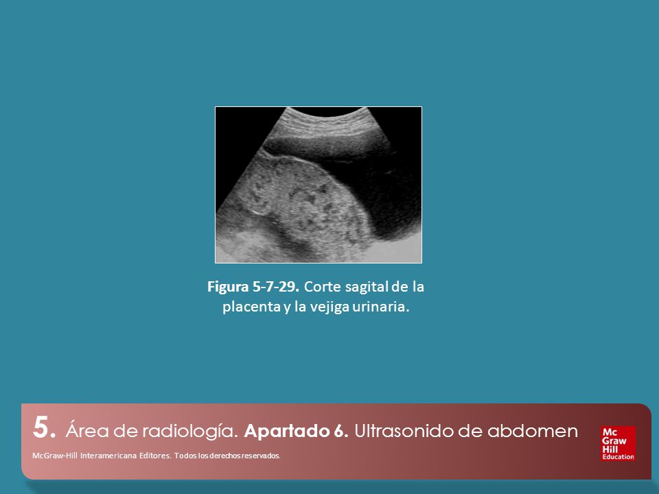 Figura Corte sagital de la placenta y la vejiga urinaria.