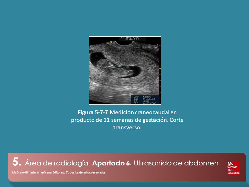 Figura Medición craneocaudal en producto de 11 semanas de gestación. Corte transverso.