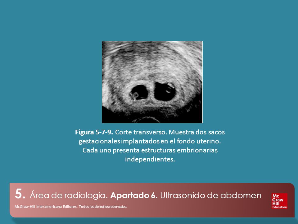 Figura Corte transverso