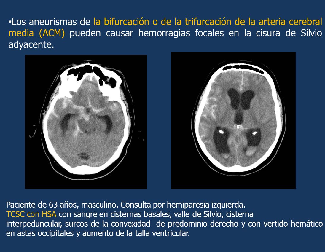Los aneurismas de la bifurcación o de la trifurcación de la arteria cerebral media (ACM) pueden causar hemorragias focales en la cisura de Silvio adyacente.