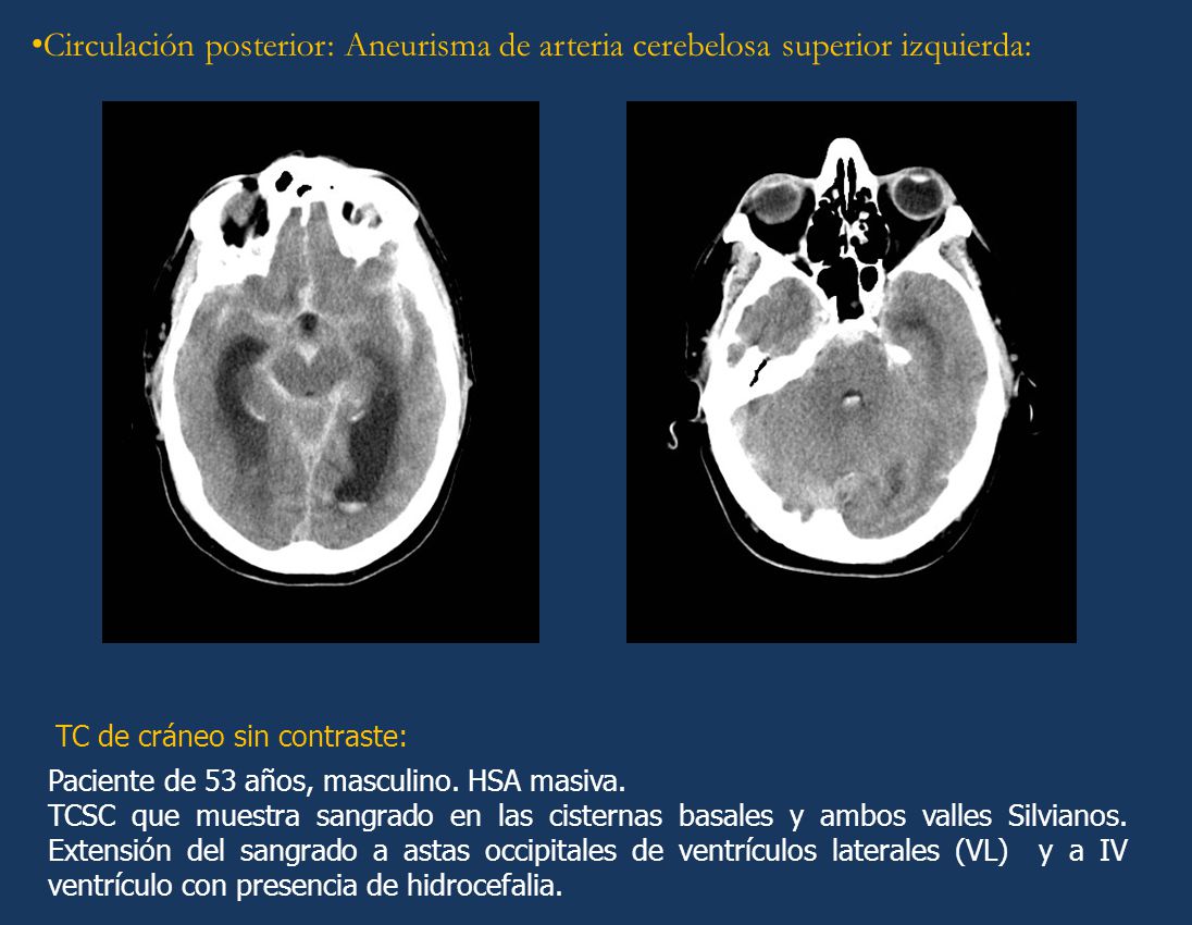 Circulación posterior: Aneurisma de arteria cerebelosa superior izquierda: