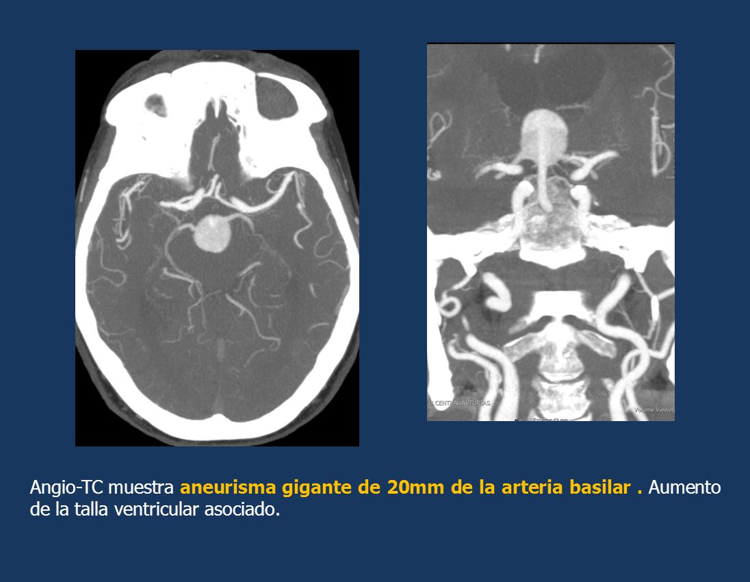 Angio-TC muestra aneurisma gigante de 20mm de la arteria basilar