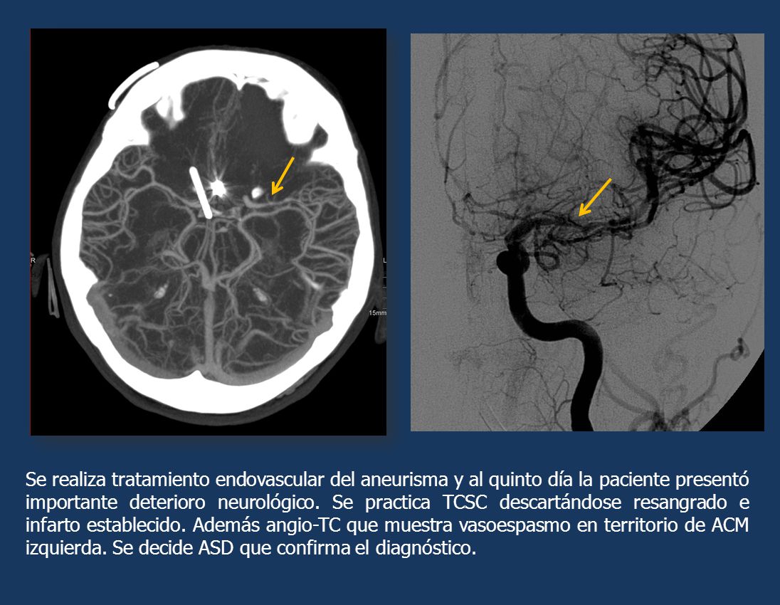 Se realiza tratamiento endovascular del aneurisma y al quinto día la paciente presentó importante deterioro neurológico.