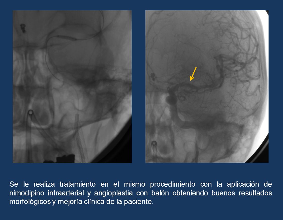 Se le realiza tratamiento en el mismo procedimiento con la aplicación de nimodipino intraarterial y angioplastia con balón obteniendo buenos resultados morfológicos y mejoría clínica de la paciente.