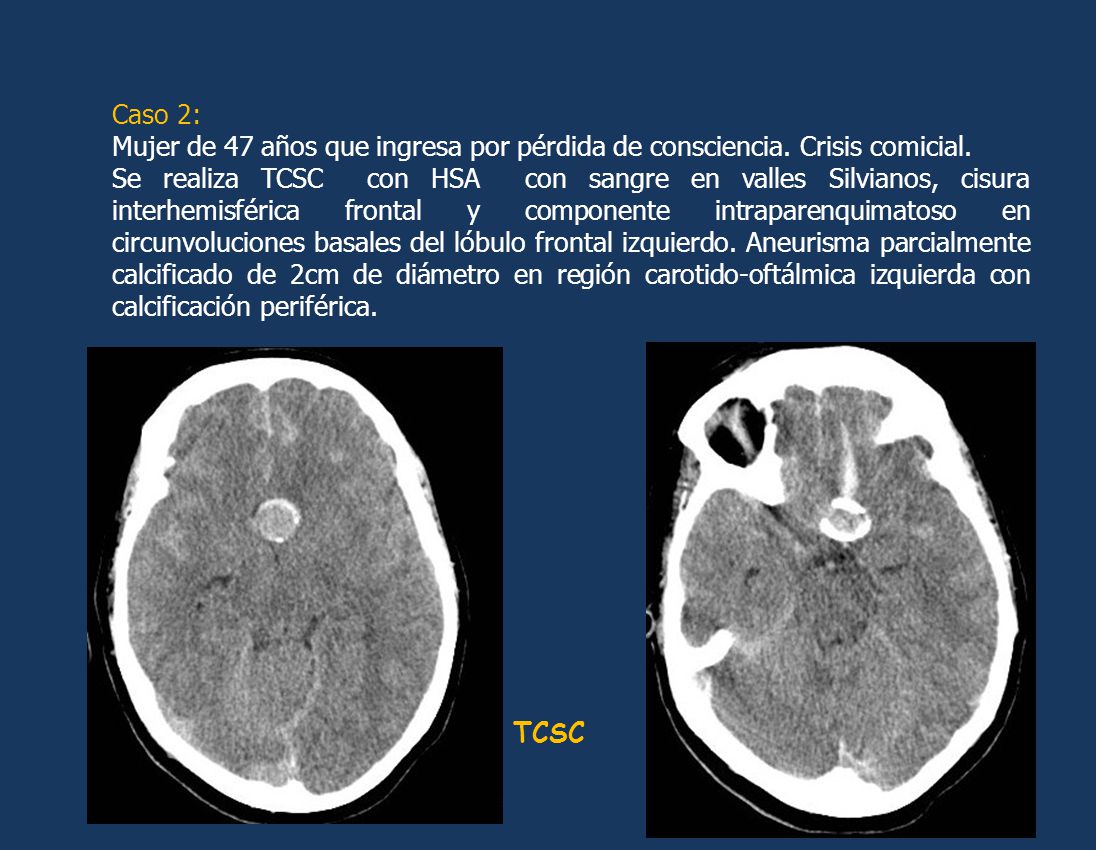 Caso 2: Mujer de 47 años que ingresa por pérdida de consciencia. Crisis comicial.