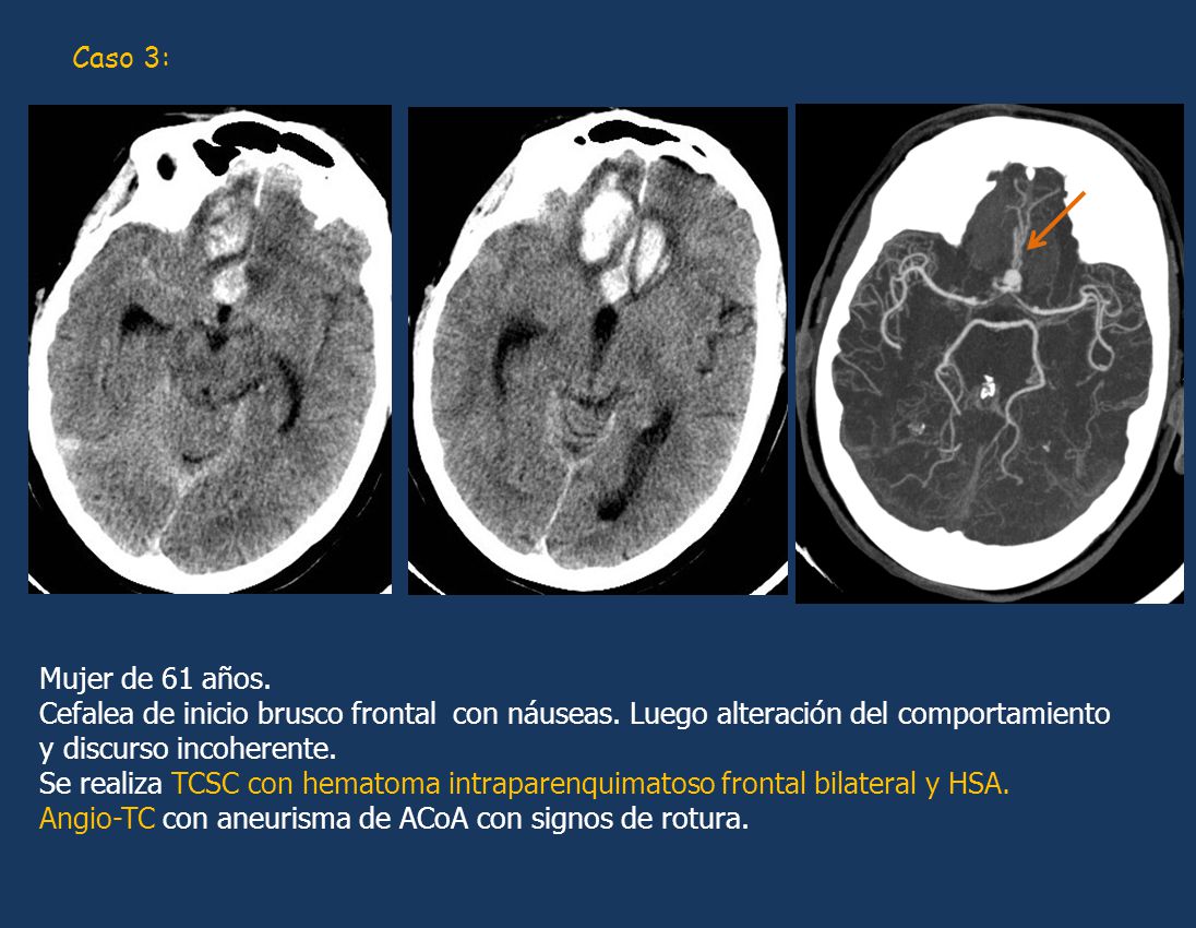 Caso 3: Mujer de 61 años. Cefalea de inicio brusco frontal con náuseas. Luego alteración del comportamiento.