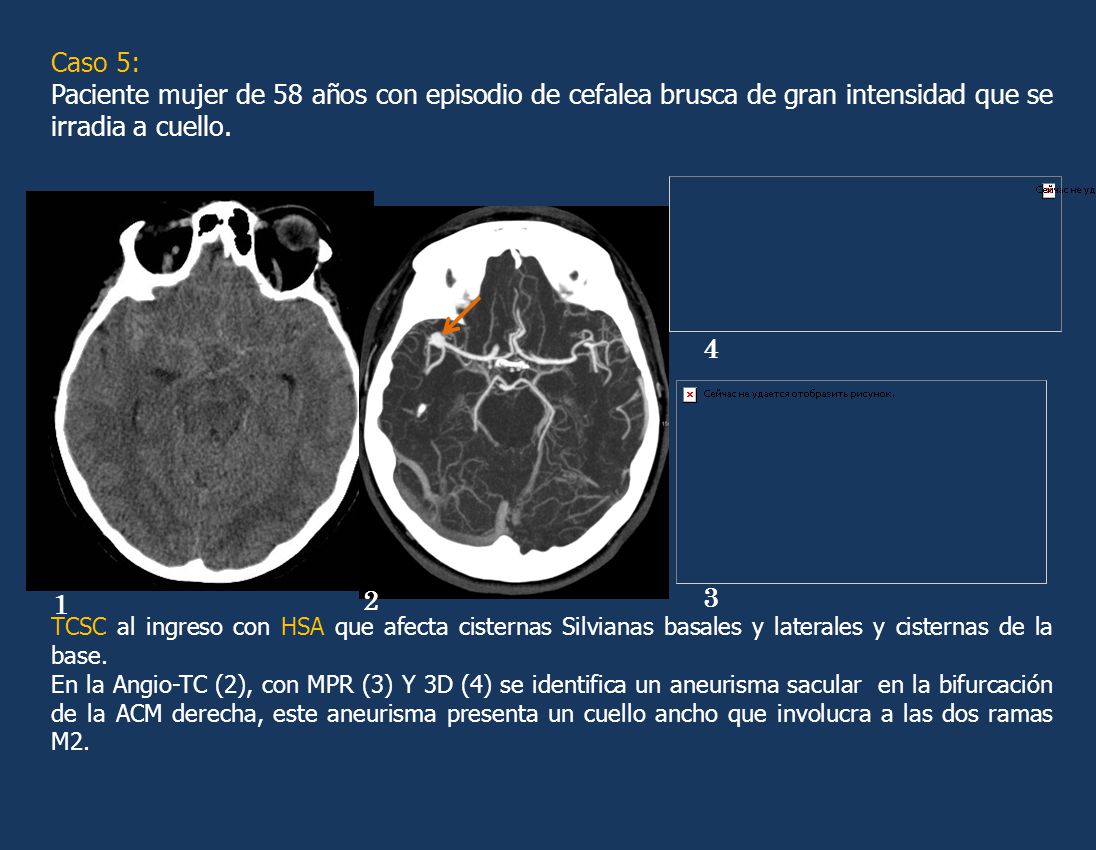 Caso 5: Paciente mujer de 58 años con episodio de cefalea brusca de gran intensidad que se irradia a cuello.