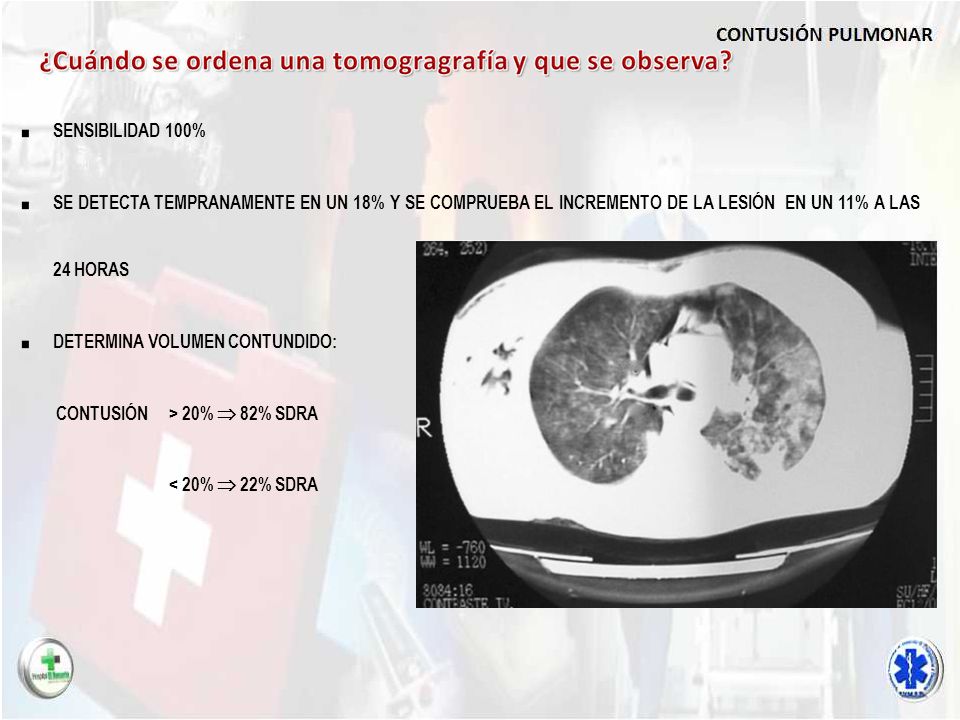 SENSIBILIDAD 100% SE DETECTA TEMPRANAMENTE EN UN 18% Y SE COMPRUEBA EL INCREMENTO DE LA LESIÓN EN UN 11% A LAS 24 HORAS.