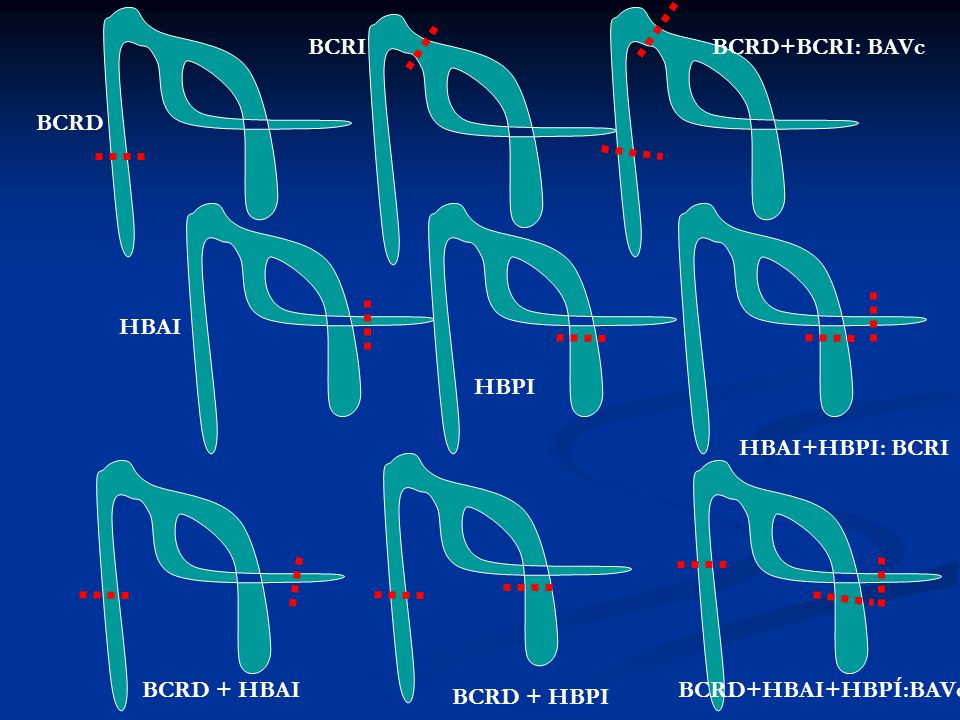 BCRI BCRD+BCRI: BAVc BCRD HBAI HBPI HBAI+HBPI: BCRI BCRD + HBAI BCRD+HBAI+HBPÍ:BAVc BCRD + HBPI