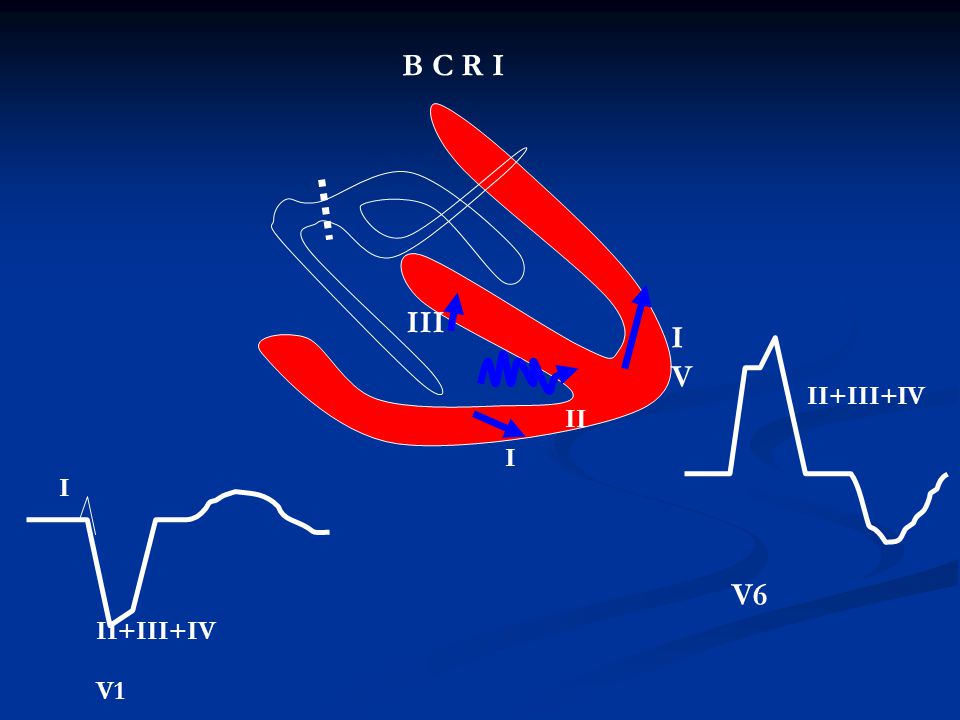 B C R I III I V II+III+IV II I I V6 II+III+IV V1