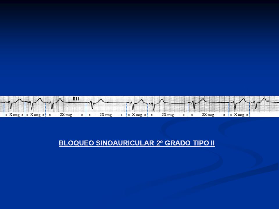 BLOQUEO SINOAURICULAR 2º GRADO TIPO II