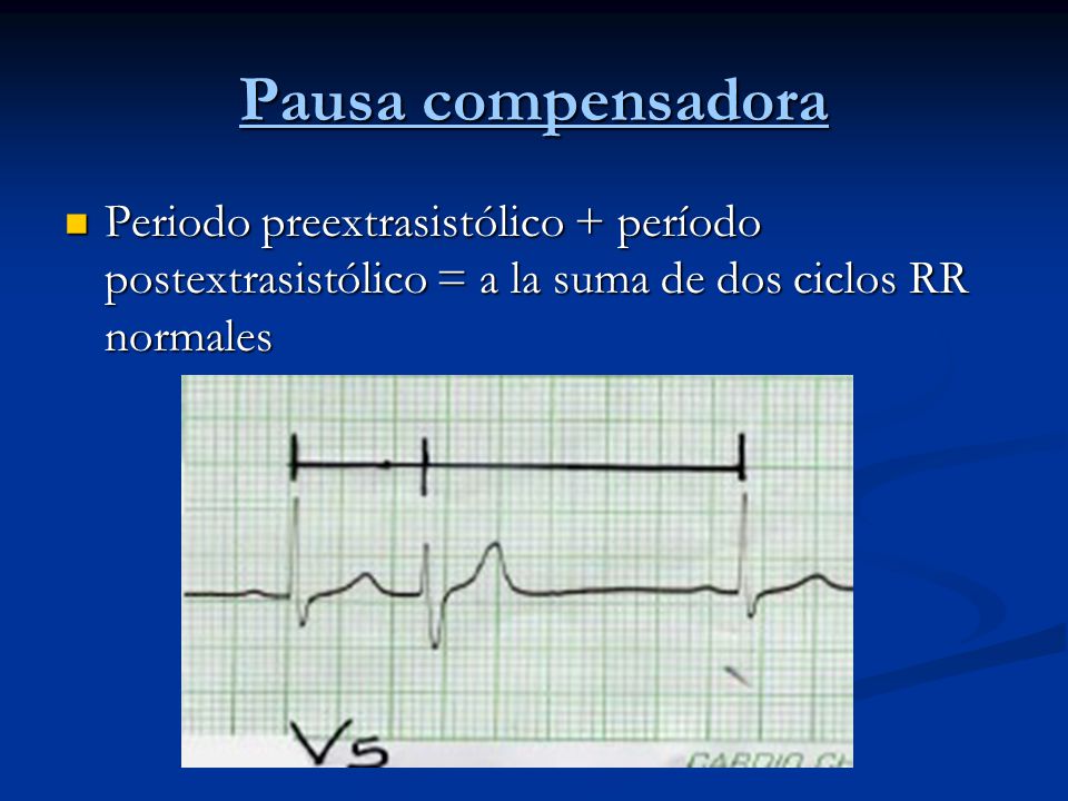 Pausa compensadora Periodo preextrasistólico + período postextrasistólico = a la suma de dos ciclos RR normales.