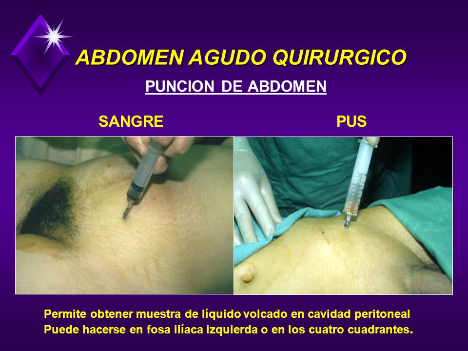 ABDOMEN AGUDO QUIRURGICO