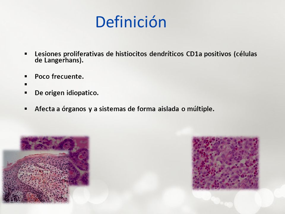 Definición Lesiones proliferativas de histiocitos dendríticos CD1a positivos (células de Langerhans).