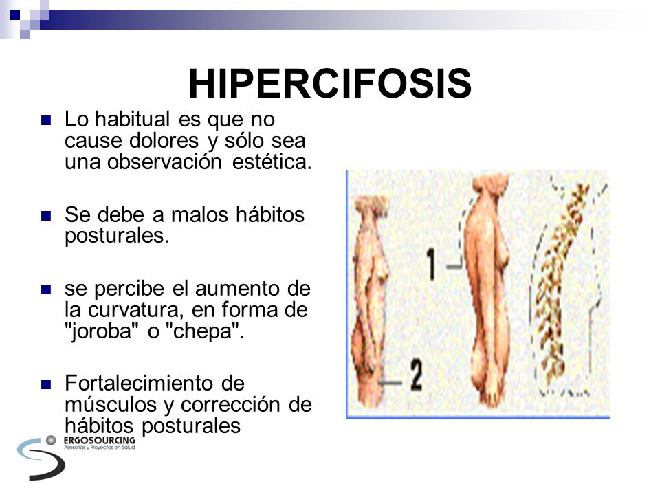 HIPERCIFOSIS Lo habitual es que no cause dolores y sólo sea una observación estética. Se debe a malos hábitos posturales.