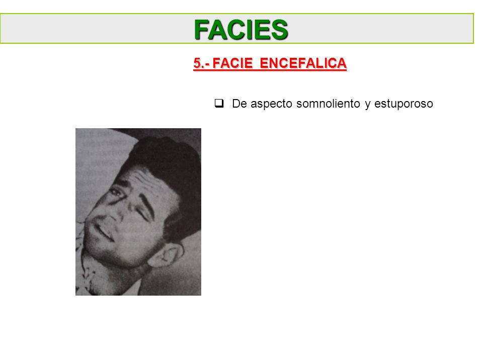 FACIES 5.- FACIE ENCEFALICA De aspecto somnoliento y estuporoso