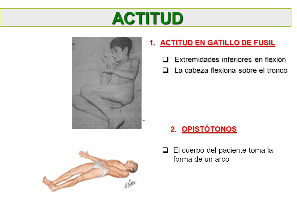 ACTITUD ACTITUD EN GATILLO DE FUSIL Extremidades inferiores en flexión