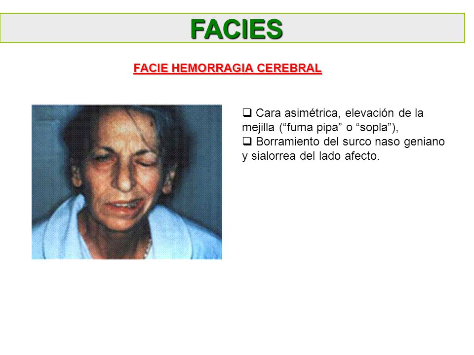 FACIES FACIE HEMORRAGIA CEREBRAL