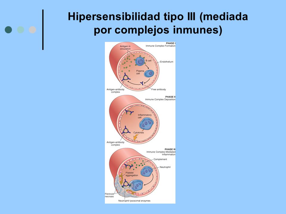 Hipersensibilidad tipo III (mediada por complejos inmunes)