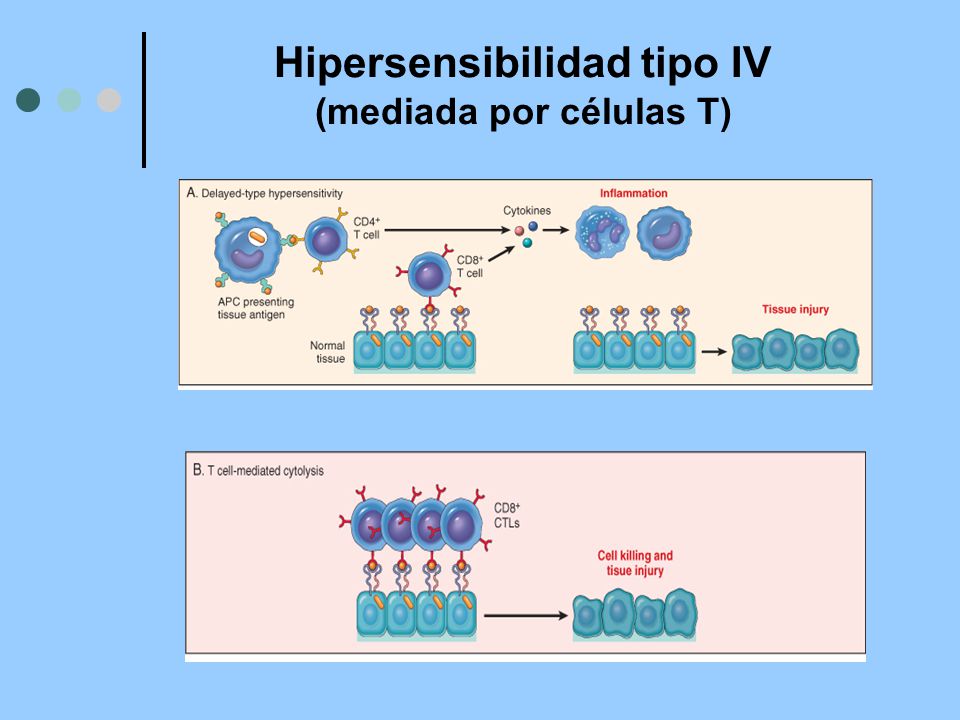 Hipersensibilidad tipo IV (mediada por células T)