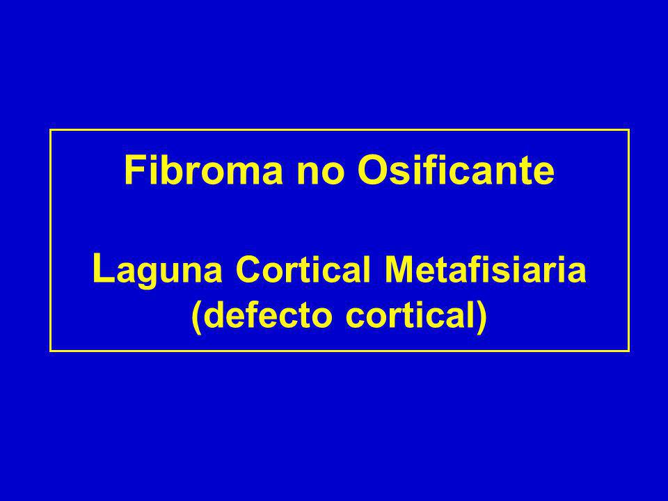 Fibroma no Osificante Laguna Cortical Metafisiaria (defecto cortical)