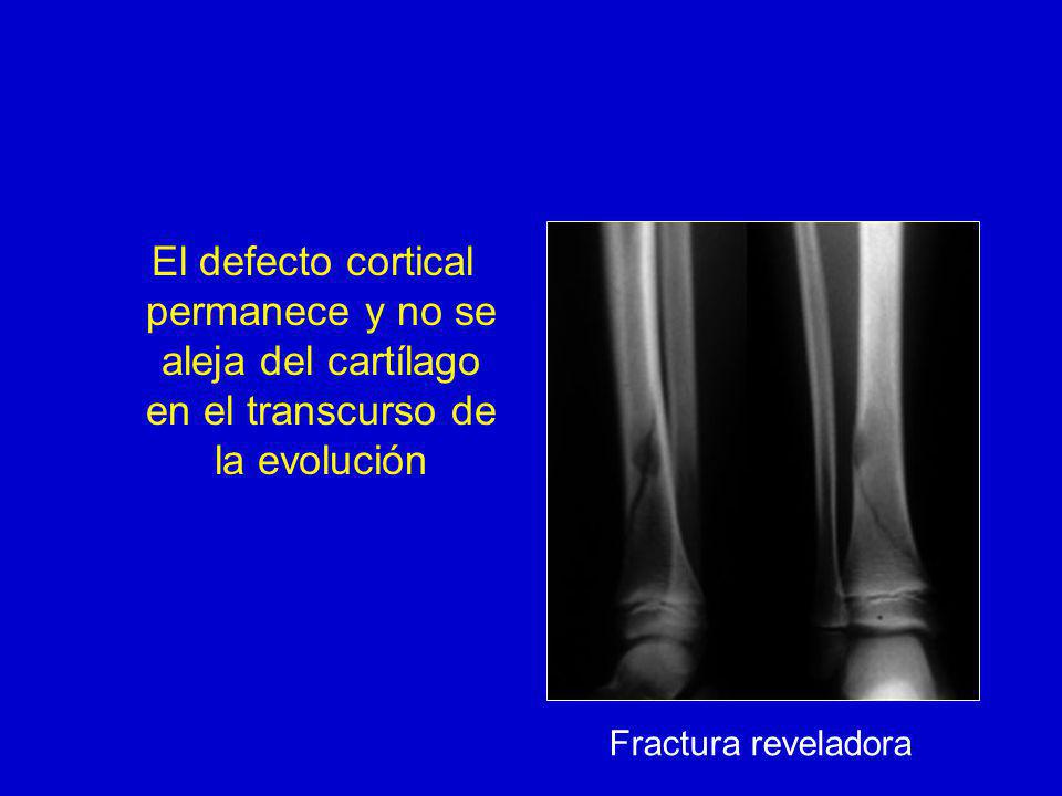 El defecto cortical permanece y no se aleja del cartílago en el transcurso de la evolución